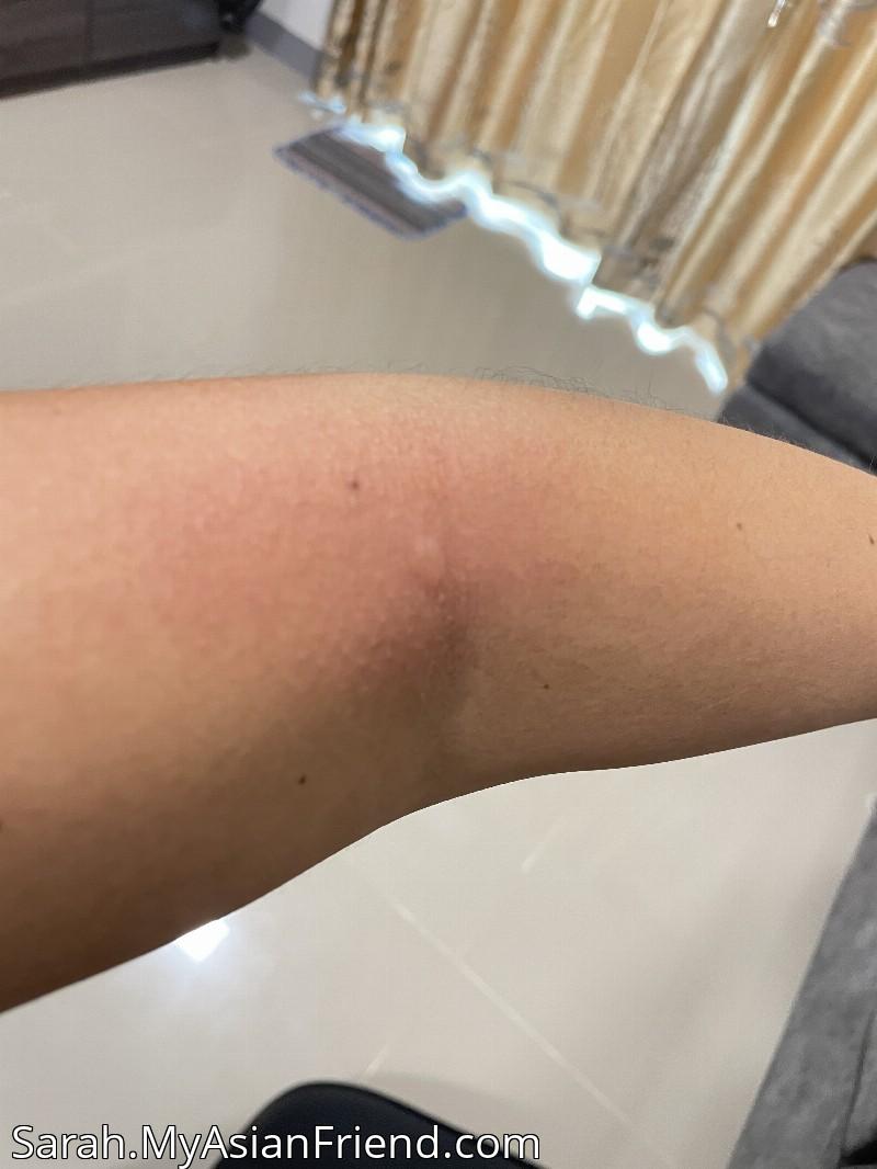 Ant Bite Drama, Your Sympathy